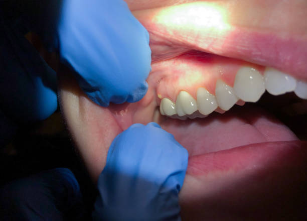 Best Chipped Tooth Repair Near Me  in Fort Davis, TX
